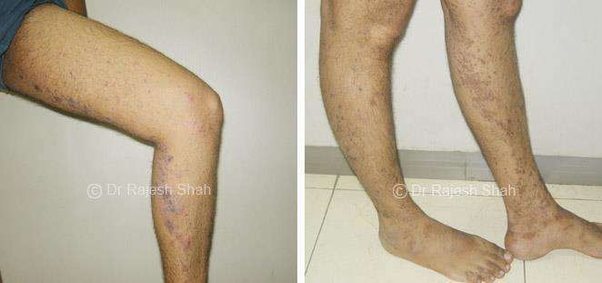 Lichen Planus Before and After Case Photo