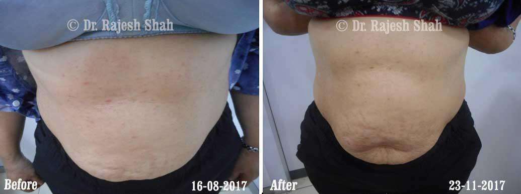 Lichen Planus Before and After Case Photo