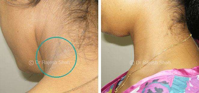 Lichen Planus Before and After Case Photo