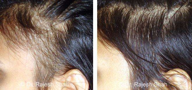 Alopecia Areata Before and After Case Photo