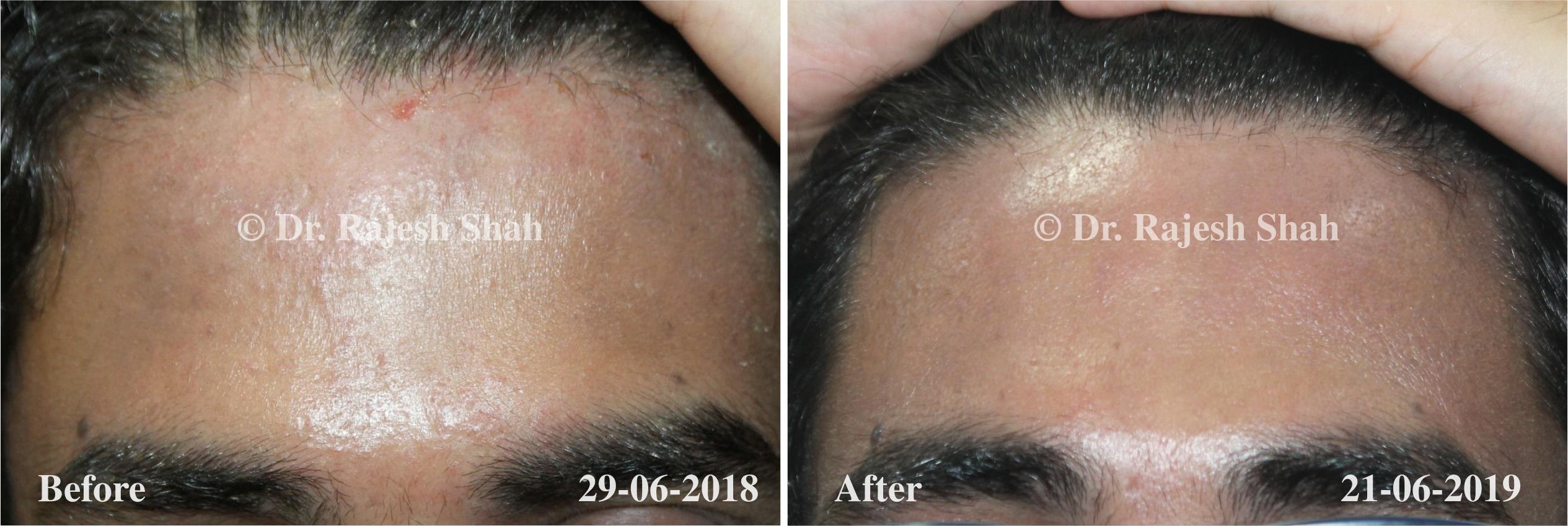 Atopic Dermatitis Before and After Case Photo