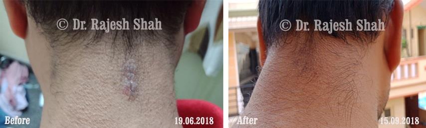 Psoriasis Before and After Case Photo