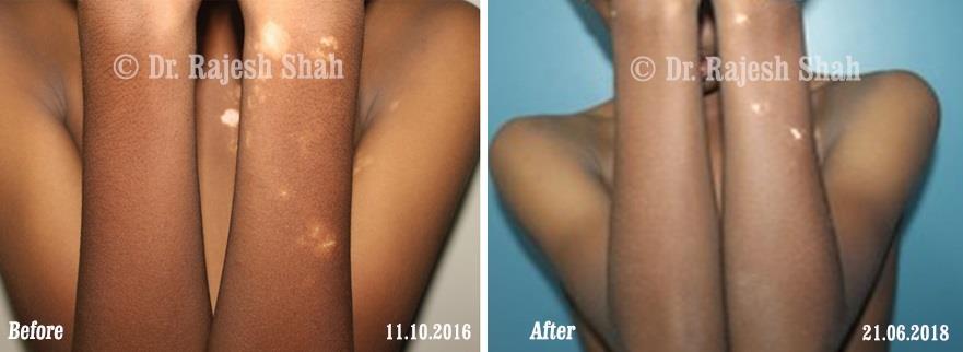 Vitiligo Before and After Case Photo