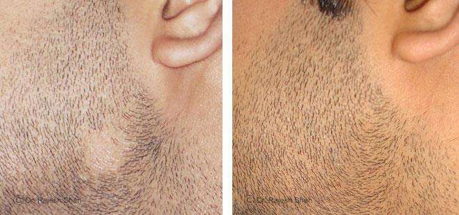 Alopecia Areata Before and After Case Photo