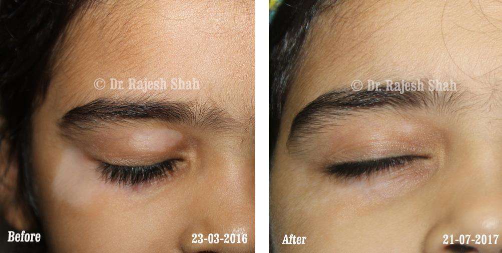 Vitiligo Before and After Case Photo