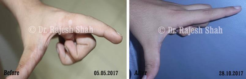 Vitiligo Before and After Case Photo