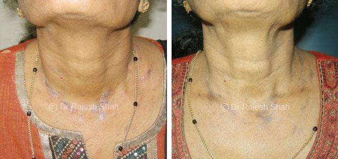 Lichen Planus Before and After Case Photo