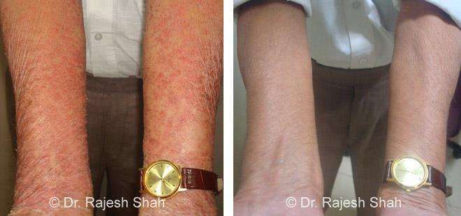 Psoriasis Before and After Case Photo
