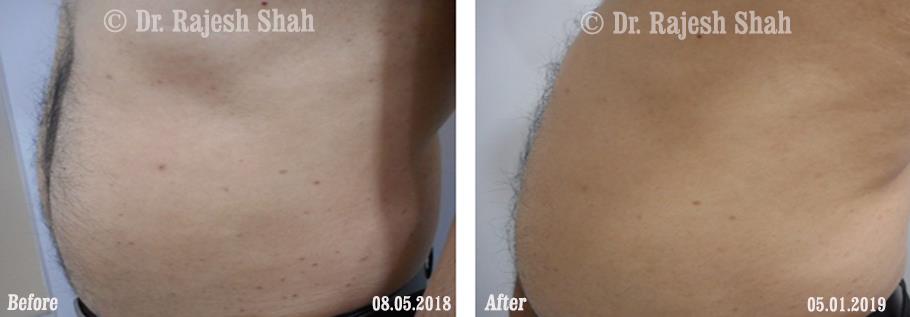 Lichen Planus Before and After Case Photo