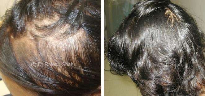 Alopecia Areata Before and After Case Photo