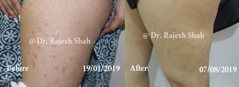 Psoriasis Before and After Case Photo