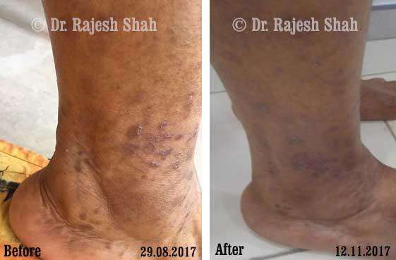 Lichen Planus Before and After Case Photo