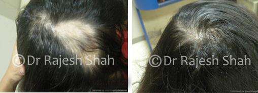 Alopecia Areata Before and After Case Photo