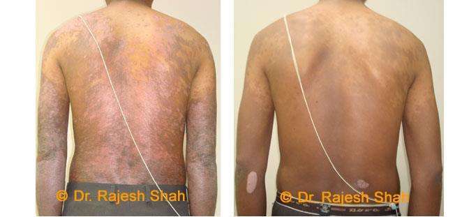 Psoriasis Before and After Case Photo