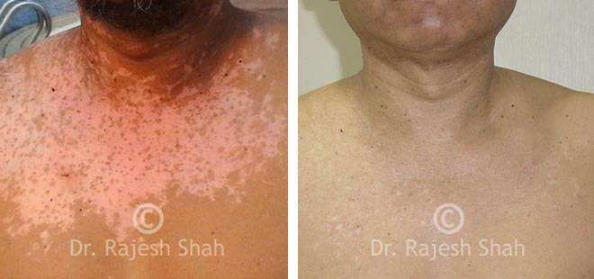 Vitiligo Before and After Case Photo