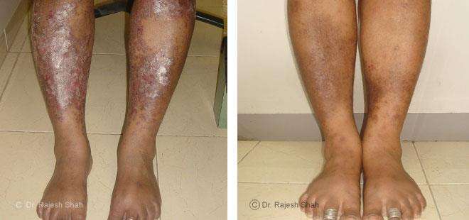 Psoriasis Before and After Case Photo