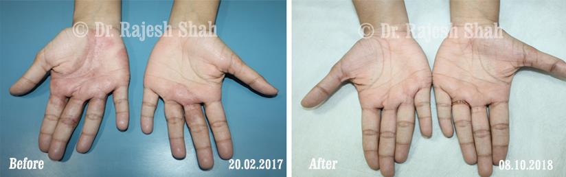 Psoriasis Before and After Case Photo