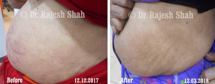 Psoriasis Before and After Case Photo