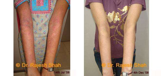 Psoriasis Before and After Case Photo