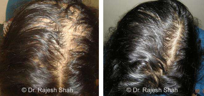 Alopecia Areata Before and After Case Photo