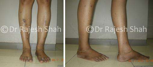 Lichen Planus Before and After Case Photo