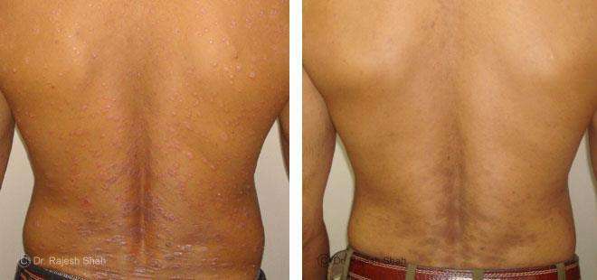 Psoriasis Before and After Case Photo