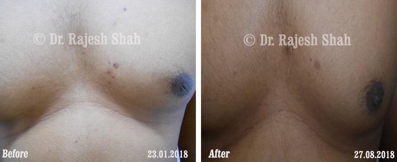 Psoriasis Before and After Case Photo