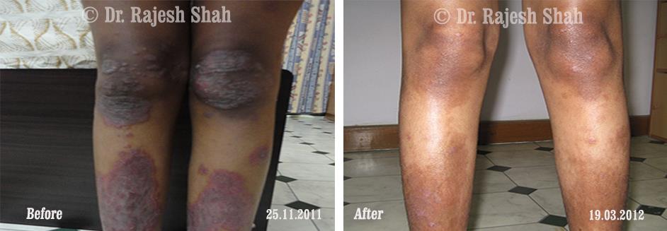 Psoriasis Before and After Case Photo