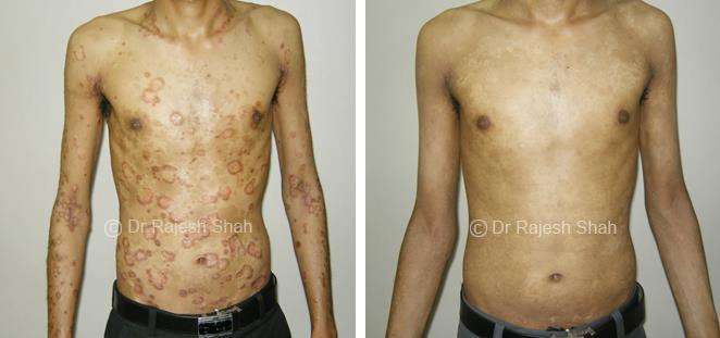 Psoriasis Before and After Case Photo