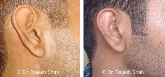Vitiligo Before and After Case Photo