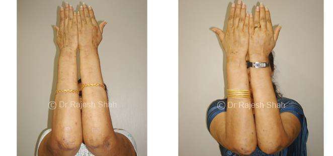 Lichen Planus Before and After Case Photo