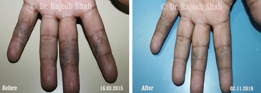 Psoriasis Before and After Case Photo