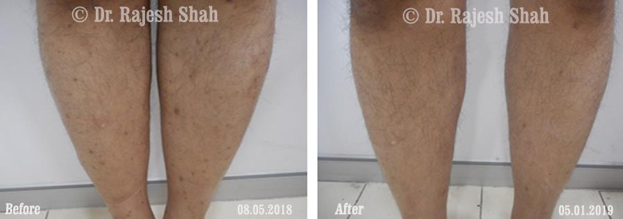 Lichen Planus Before and After Case Photo