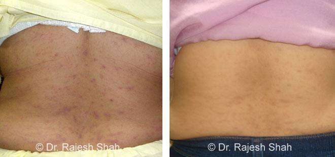 Lichen Planus Before and After Case Photo