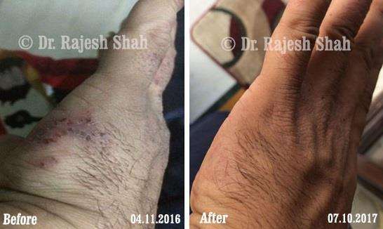 Atopic Dermatitis Before and After Case Photo