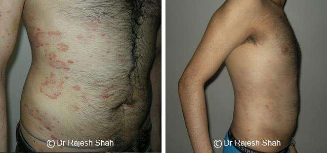 Psoriasis Before and After Case Photo
