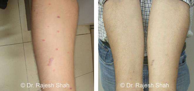 Lichen Planus Before and After Case Photo