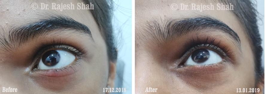 Chalazion Before and After Case Photo