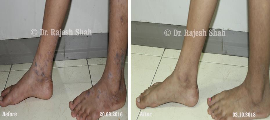 Lichen Planus Before and After Case Photo