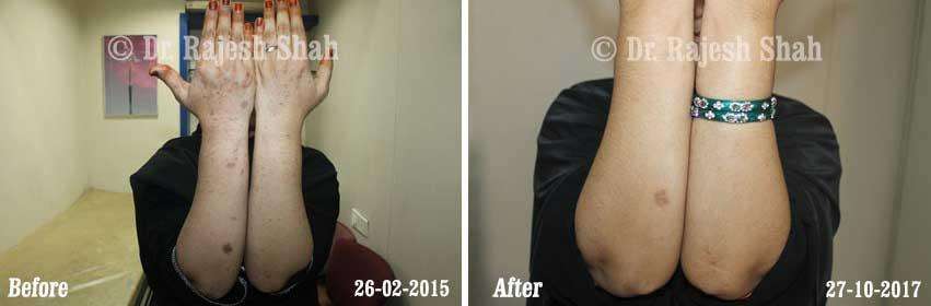 Lichen Planus Before and After Case Photo