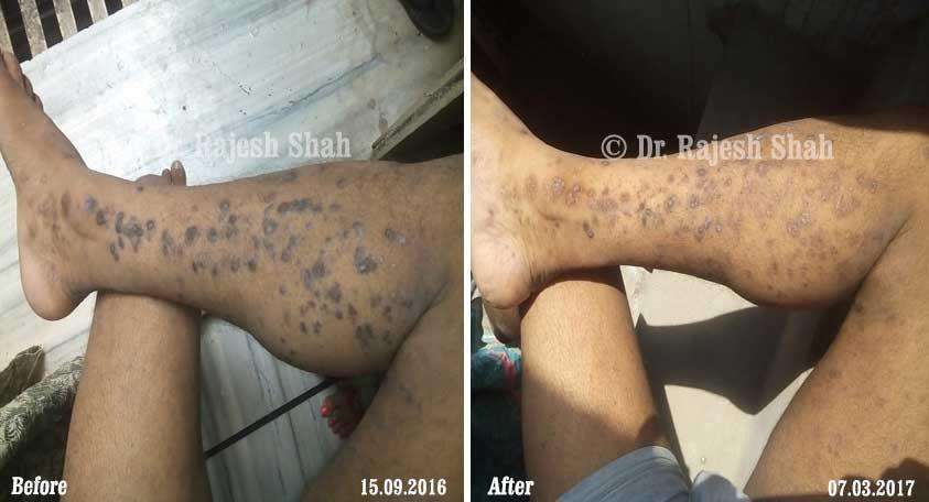 Lichen Planus Before and After Case Photo