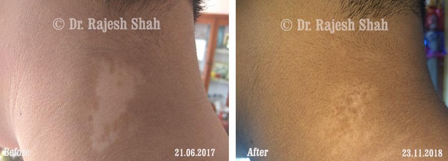 Vitiligo Before and After Case Photo