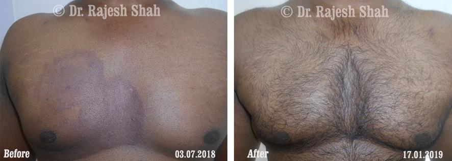 Psoriasis Before and After Case Photo