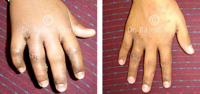 Eczema Before and After Case Photo