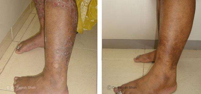Psoriasis Before and After Case Photo