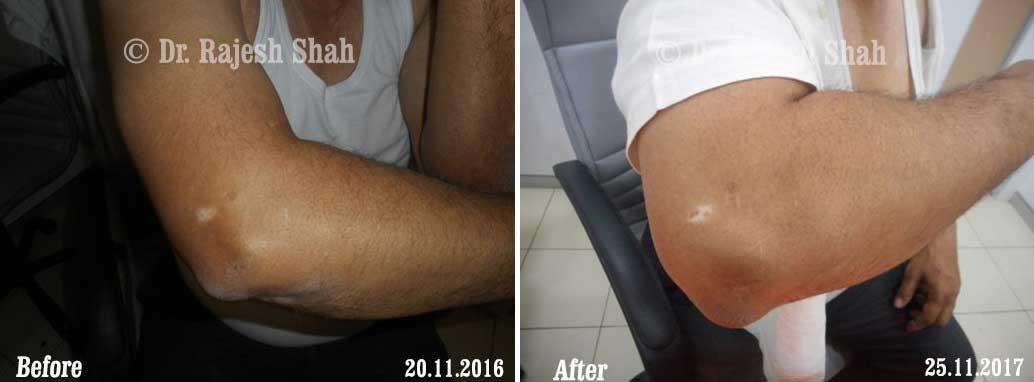 Vitiligo Before and After Case Photo