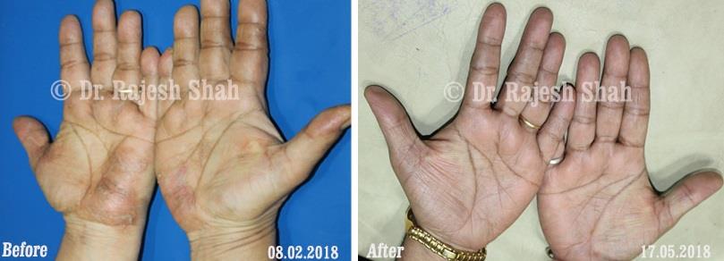 Psoriasis Before and After Case Photo