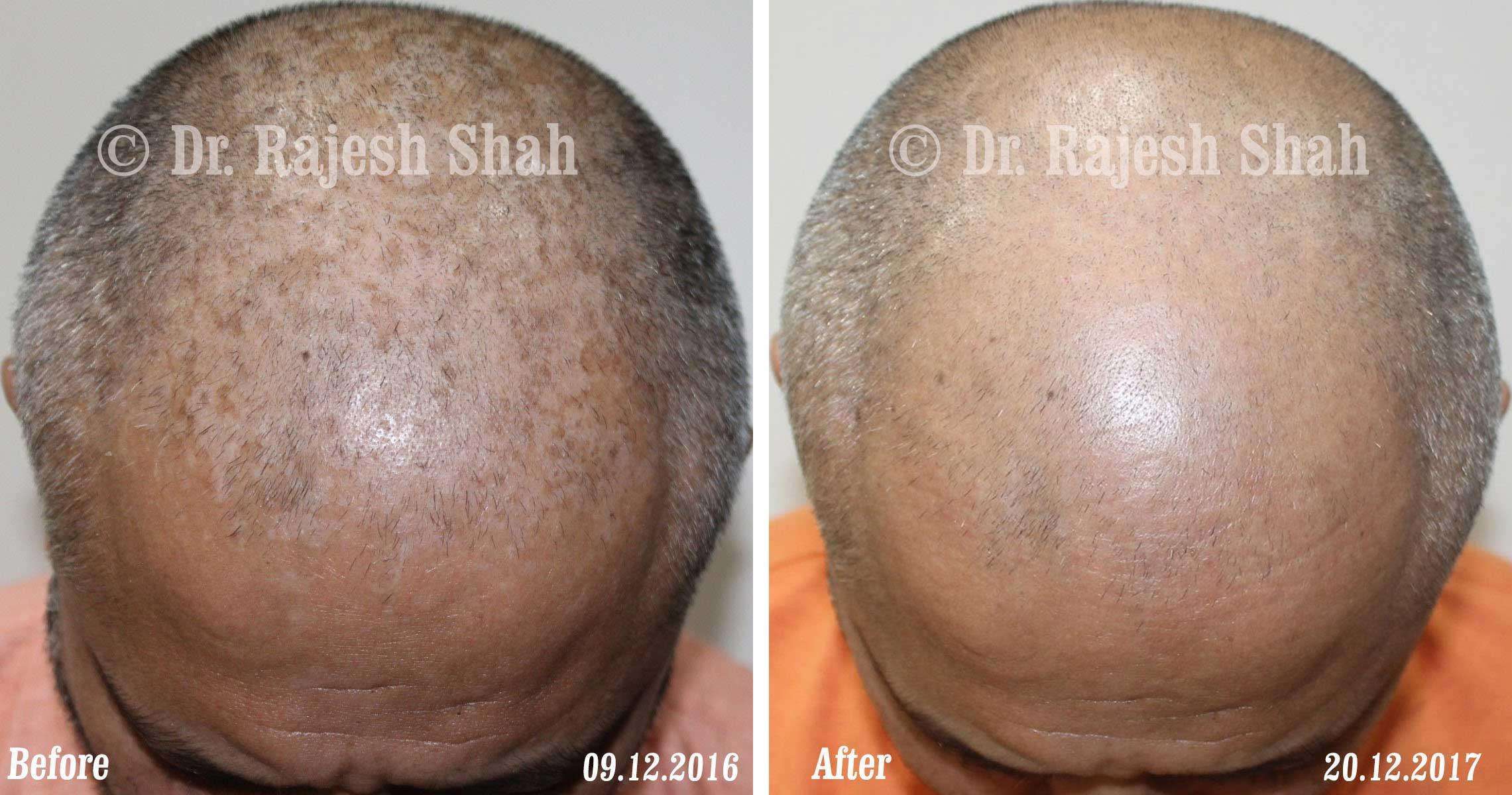 Psoriasis Before and After Case Photo