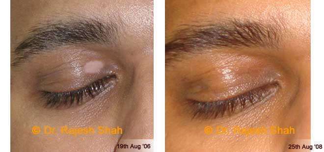 Vitiligo Before and After Case Photo