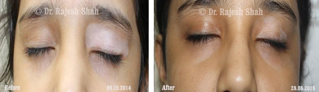 Vitiligo Before and After Case Photo